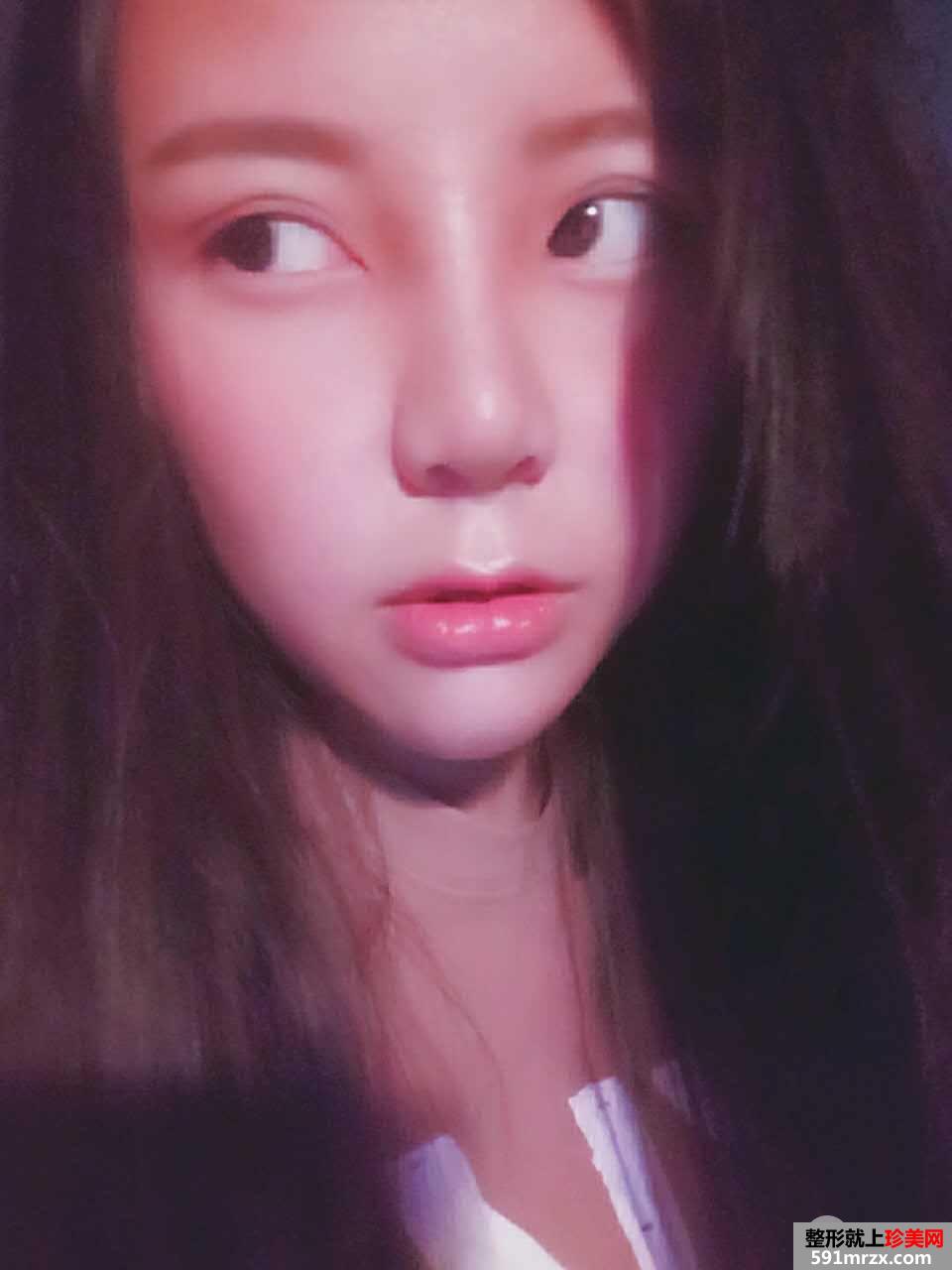 韩式生科假体隆鼻+耳软骨垫鼻尖前后对比分享，效果超乎想象