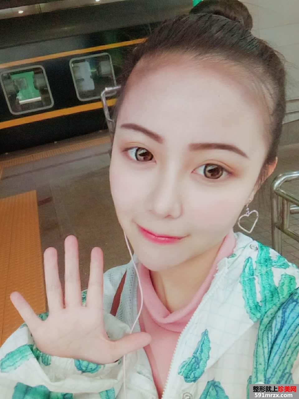 韩式生科假体隆鼻+耳软骨垫鼻尖前后对比分享，效果超乎想象