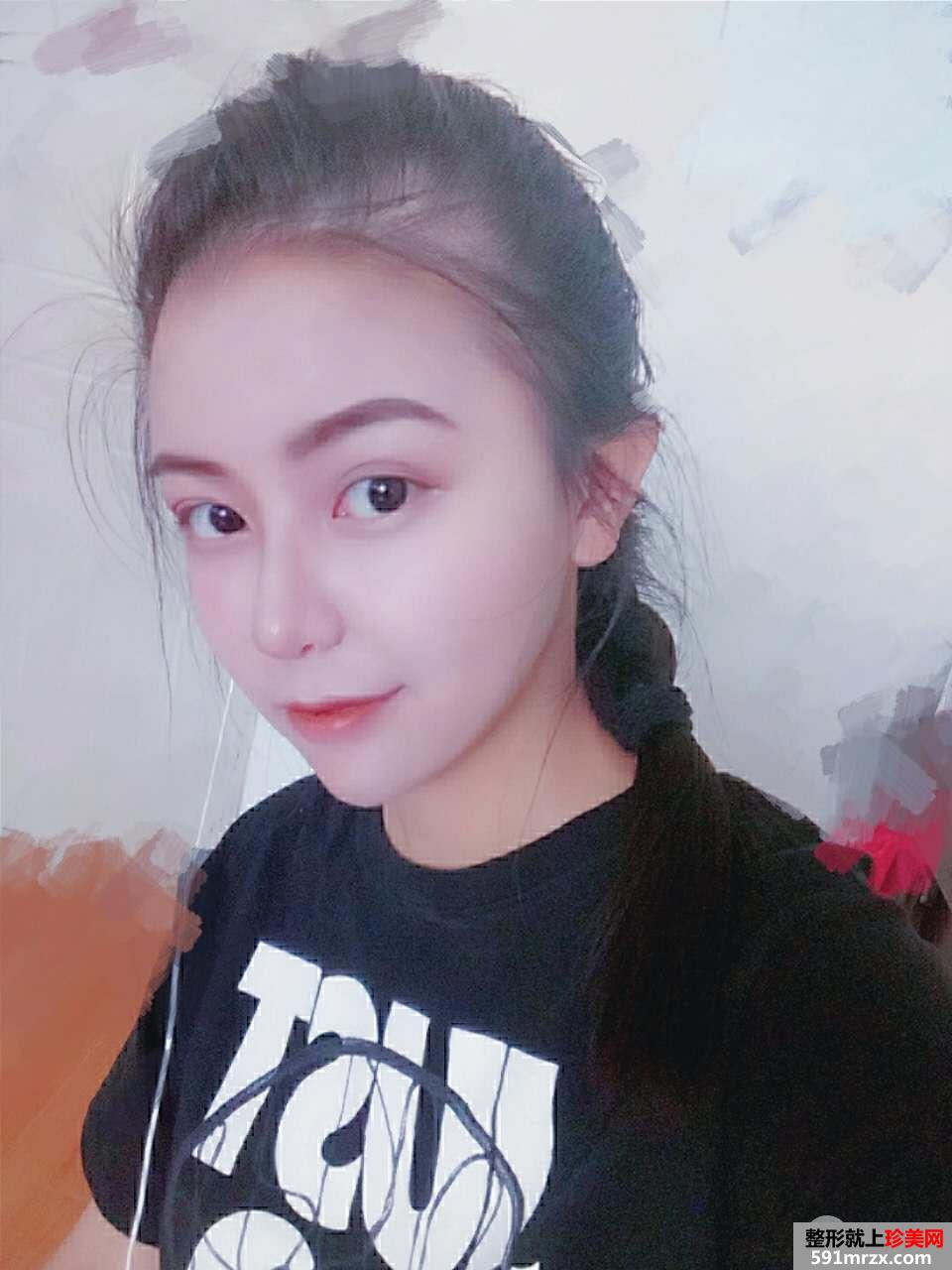 韩式生科假体隆鼻+耳软骨垫鼻尖前后对比分享，效果超乎想象