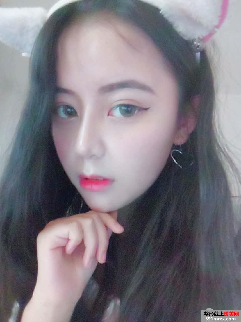 韩式生科假体隆鼻+耳软骨垫鼻尖前后对比分享，效果超乎想象