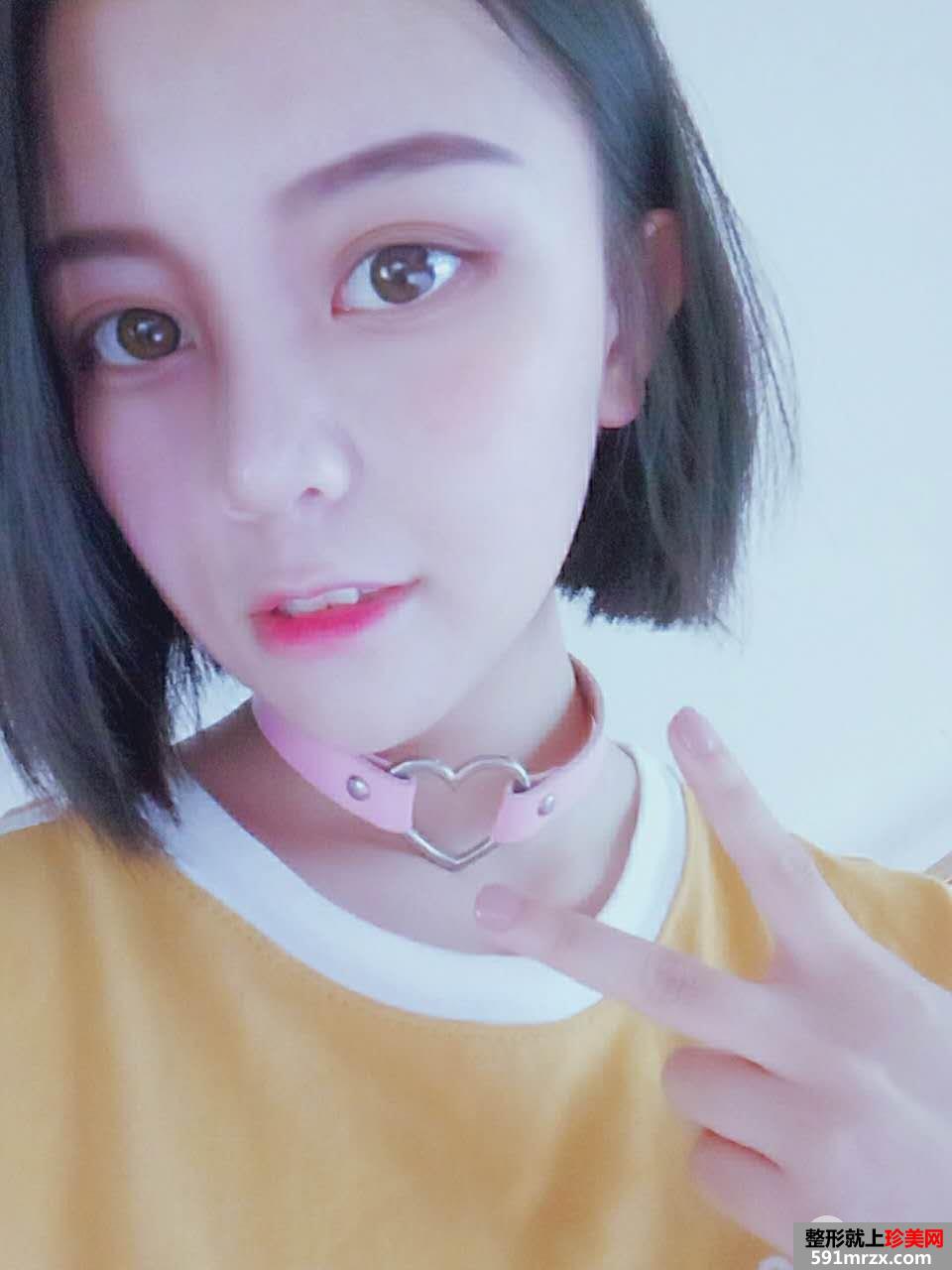 韩式生科假体隆鼻+耳软骨垫鼻尖前后对比分享，效果超乎想象