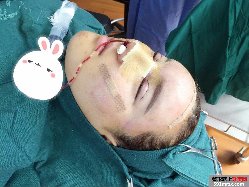鼻综合+自体脂肪面部填充前后对比照片，真实案例分享