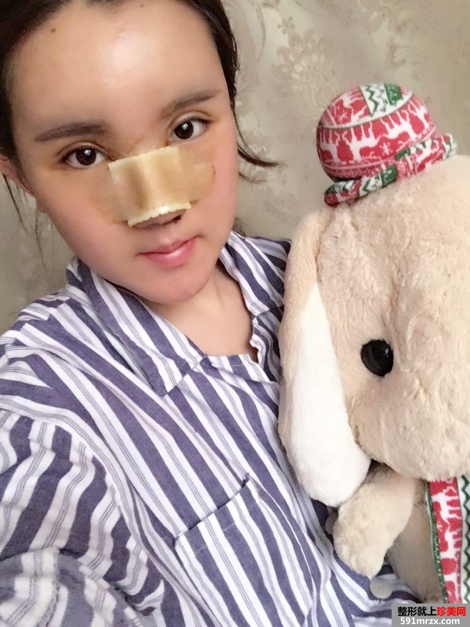 鼻综合+自体脂肪面部填充前后对比照片，真实案例分享