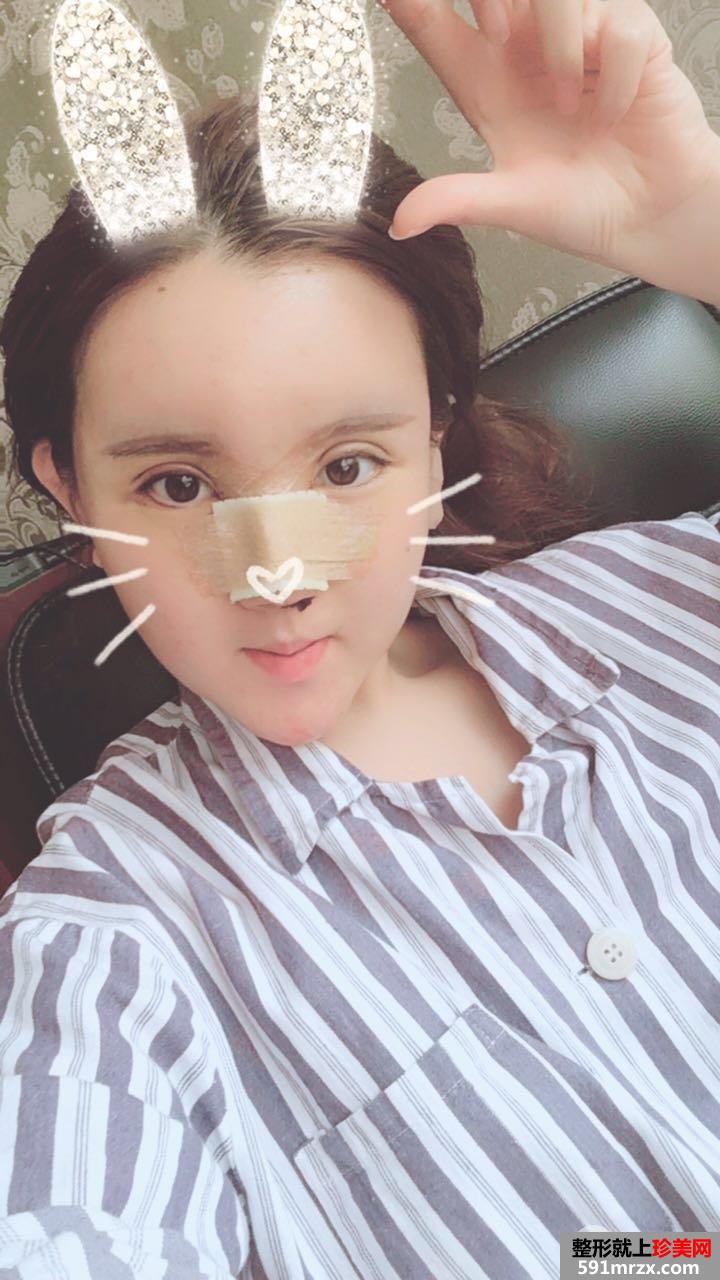 鼻综合+自体脂肪面部填充前后对比照片，真实案例分享