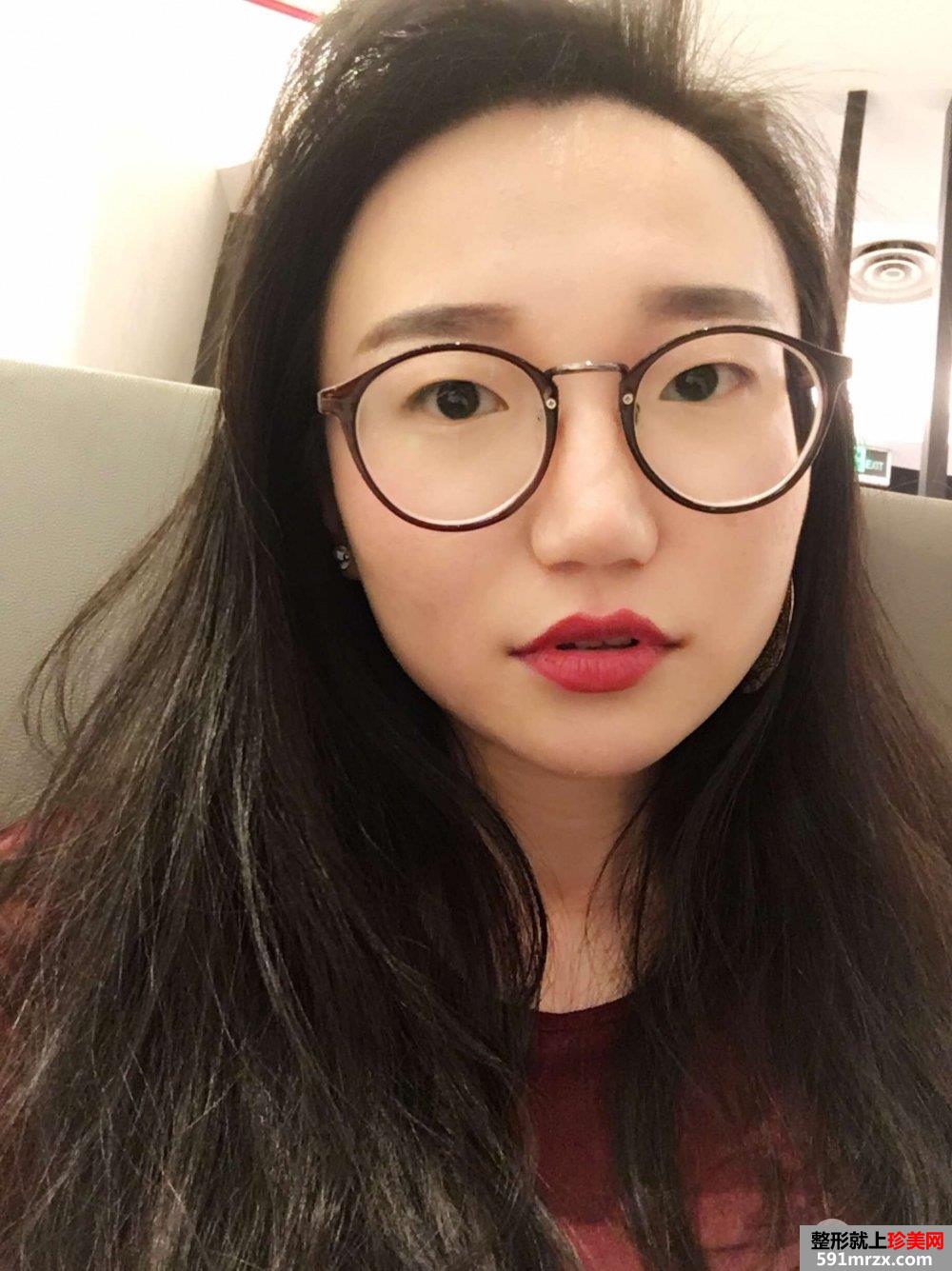 切开双眼皮开眼角真实记录，有图有真相