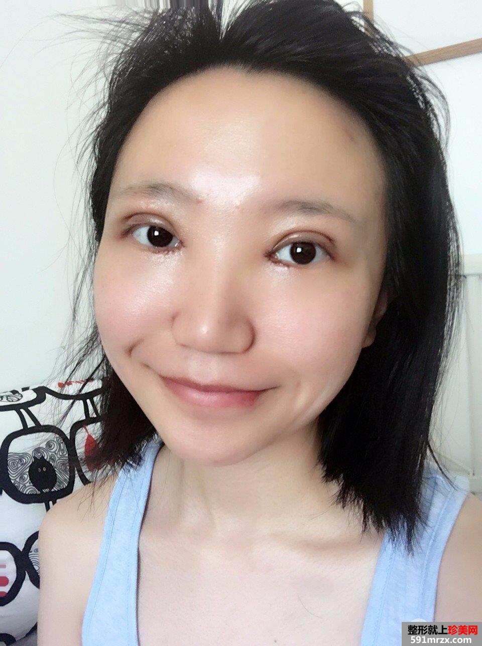 切开双眼皮开眼角真实记录，有图有真相