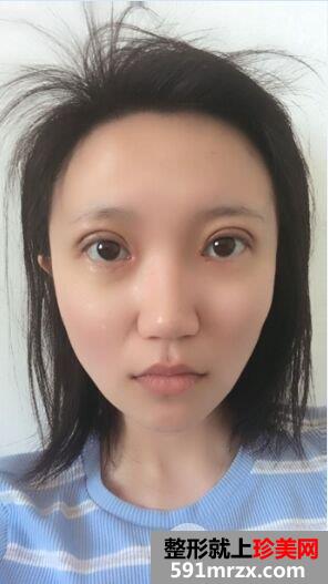 切开双眼皮开眼角真实记录，有图有真相
