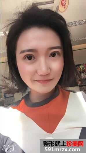 切开双眼皮开眼角真实记录，有图有真相