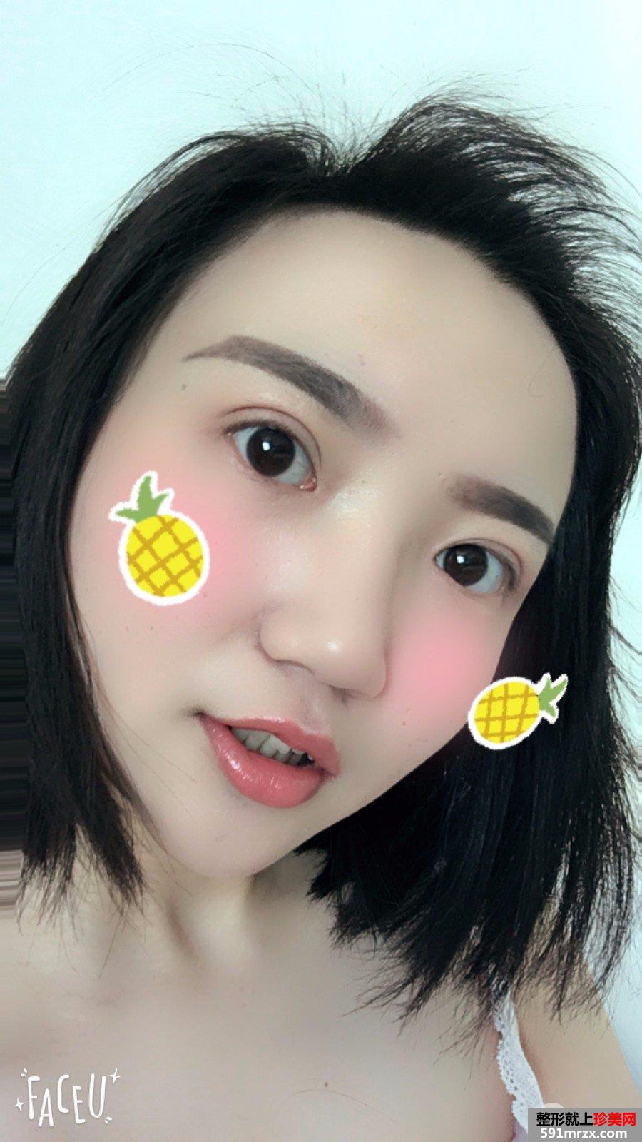 切开双眼皮开眼角真实记录，有图有真相