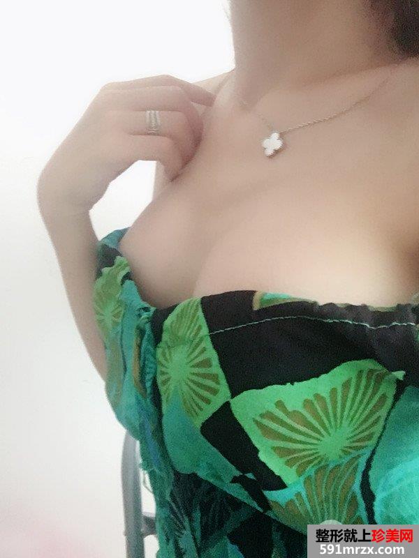 娜绮丽假体隆胸一个月恢复对比照片，整体气质UP!UP !