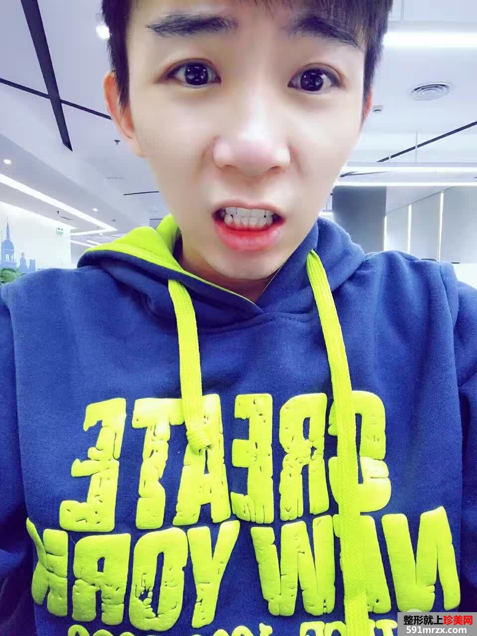 男生割双眼皮价格双眼皮术后三个月真实案例对比图