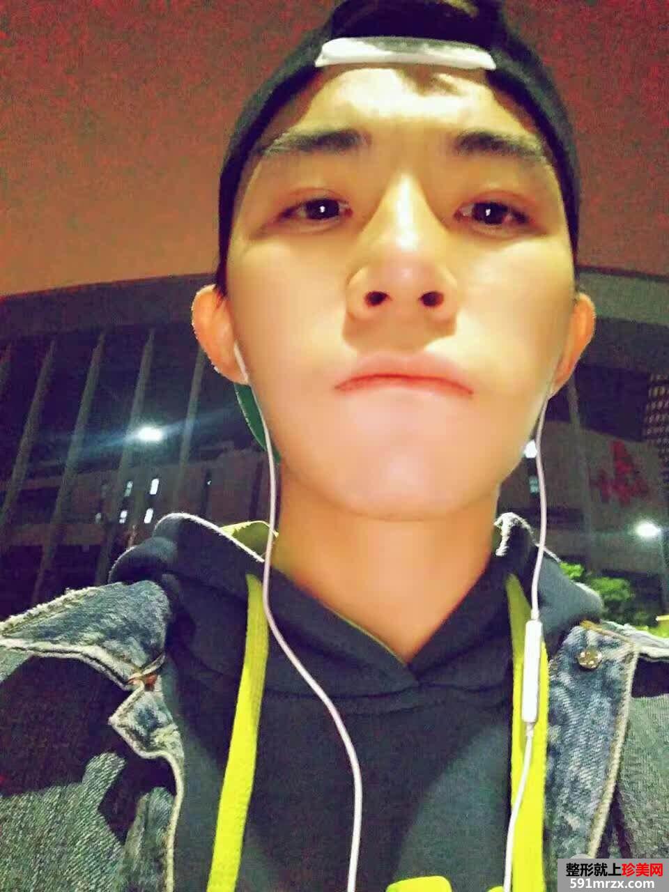 男生割双眼皮价格双眼皮术后三个月真实案例对比图