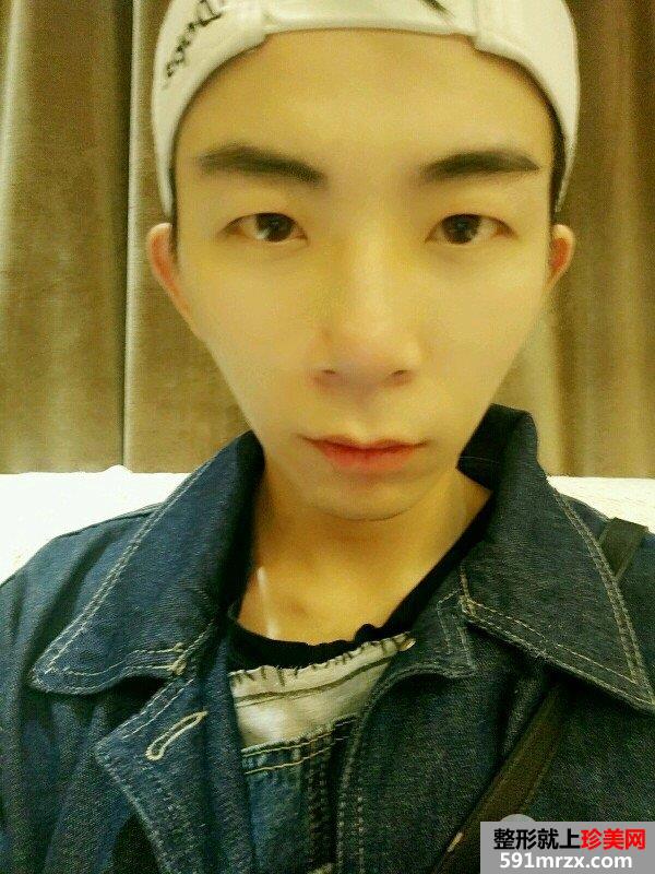男生割双眼皮价格双眼皮术后三个月真实案例对比图
