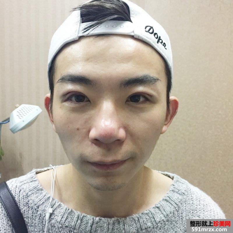 男生割双眼皮价格双眼皮术后三个月真实案例对比图