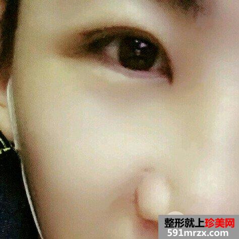 男生割双眼皮价格双眼皮术后三个月真实案例对比图