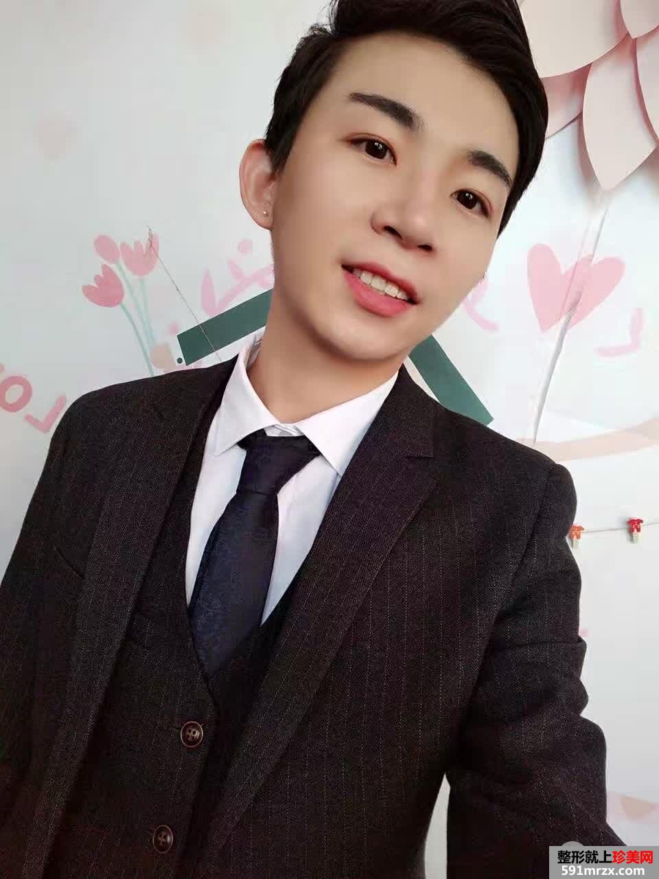 男生割双眼皮价格双眼皮术后三个月真实案例对比图