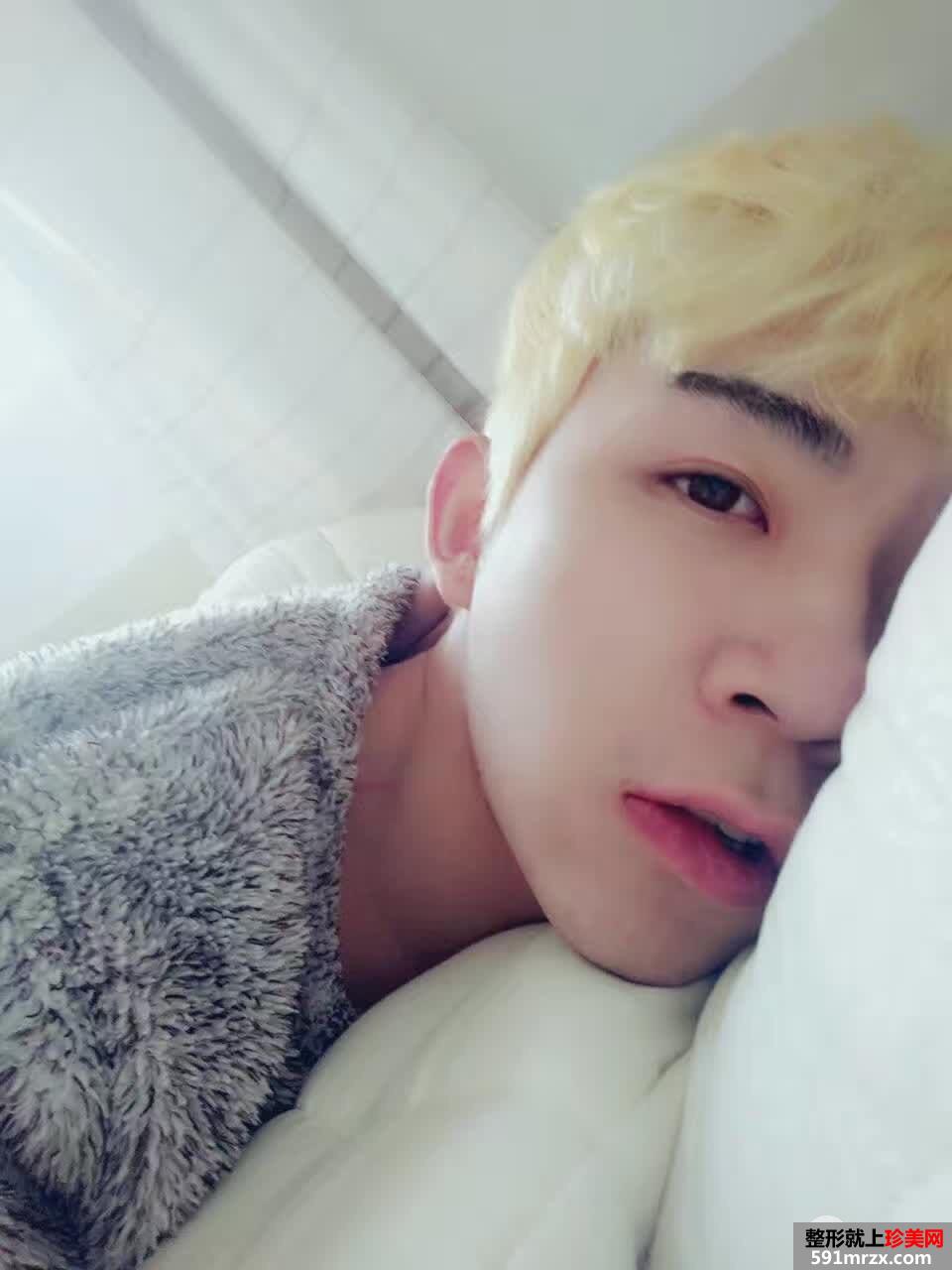 男生割双眼皮价格双眼皮术后三个月真实案例对比图