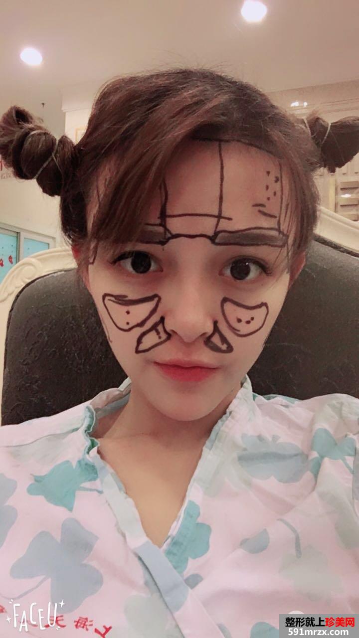 全面部自体脂肪填充手术过程分享，谁能说我不是少女