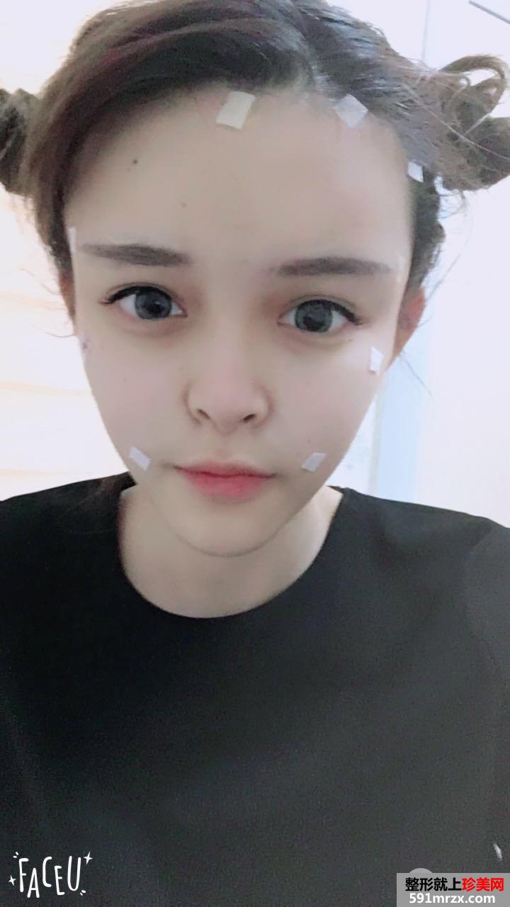 全面部自体脂肪填充手术过程分享，谁能说我不是少女