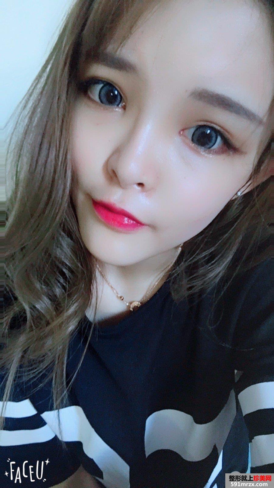 全面部自体脂肪填充手术过程分享，谁能说我不是少女