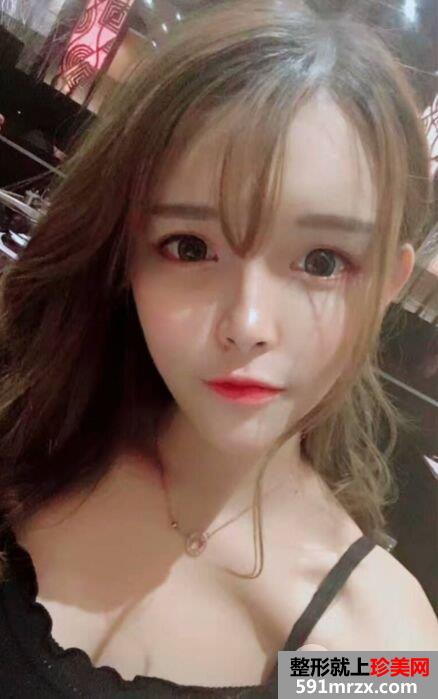 全面部自体脂肪填充手术过程分享，谁能说我不是少女
