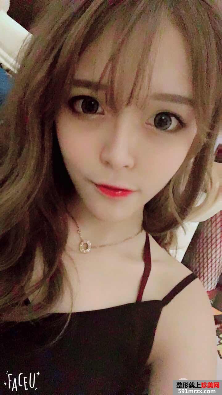 全面部自体脂肪填充手术过程分享，谁能说我不是少女