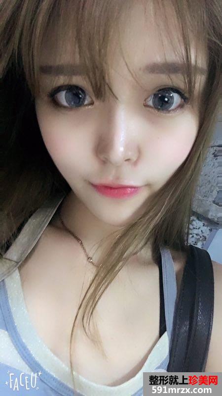 全面部自体脂肪填充手术过程分享，谁能说我不是少女