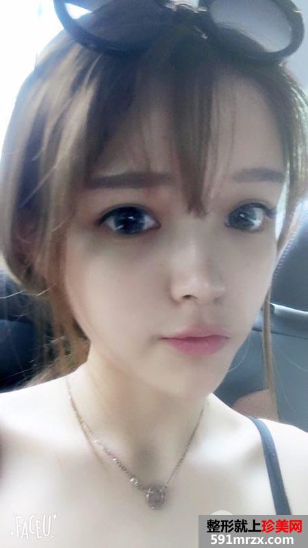全面部自体脂肪填充手术过程分享，谁能说我不是少女