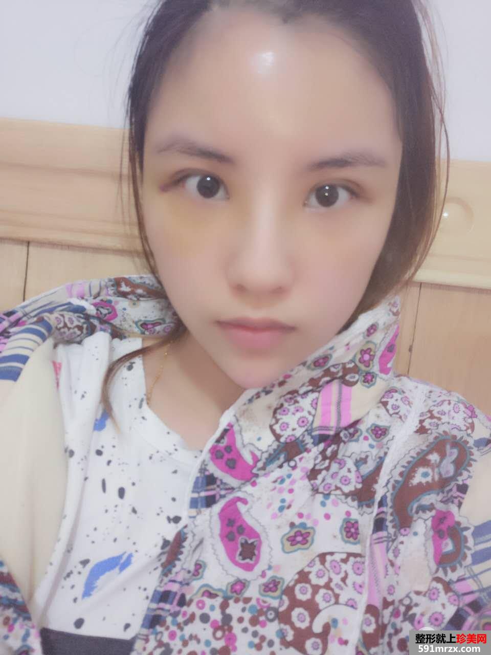 PRP自体脂肪面部填充效果图分享 脂肪存活率更高