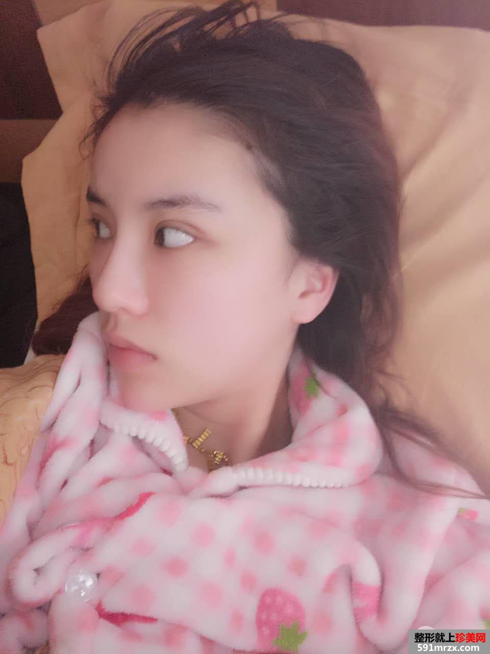 PRP自体脂肪面部填充效果图分享 脂肪存活率更高