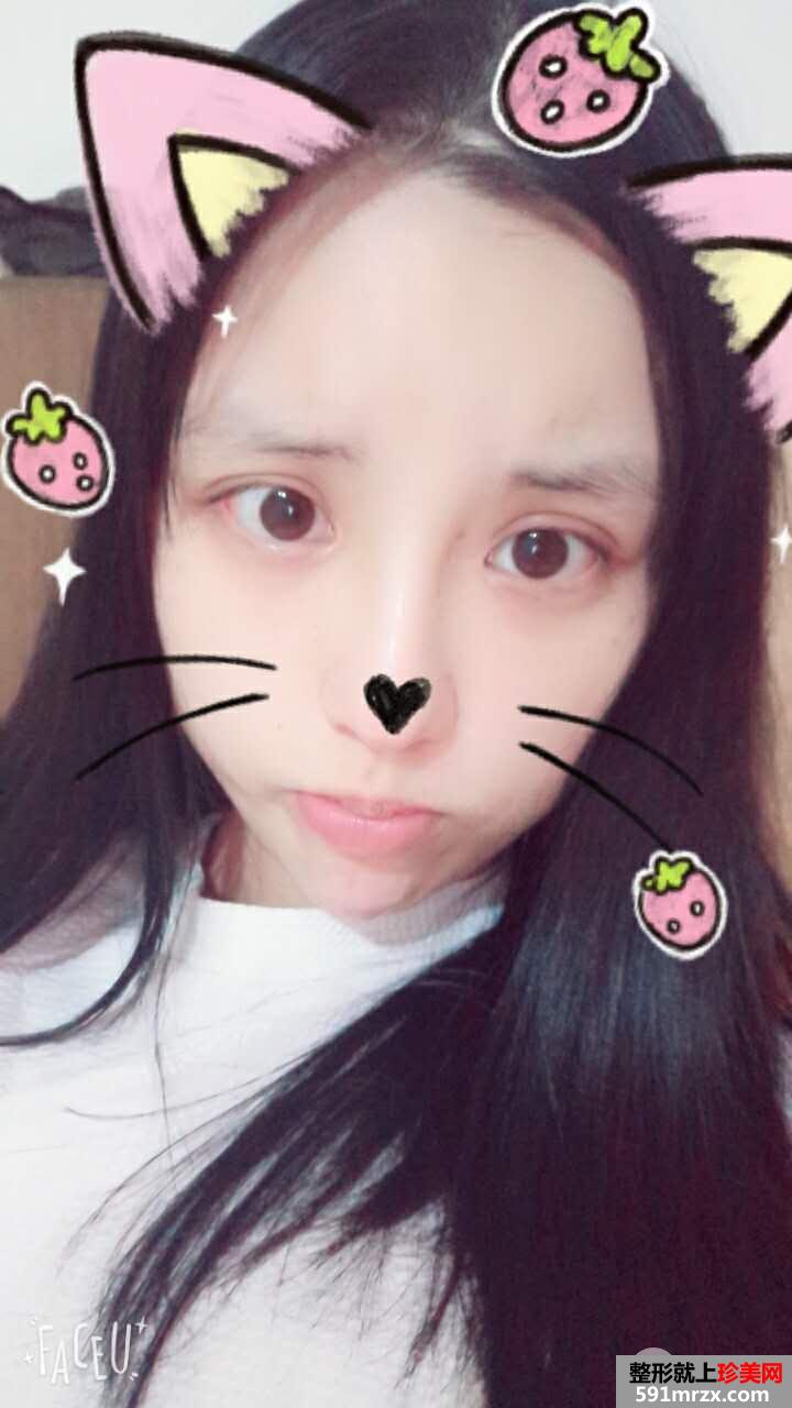 PRP自体脂肪面部填充效果图分享 脂肪存活率更高