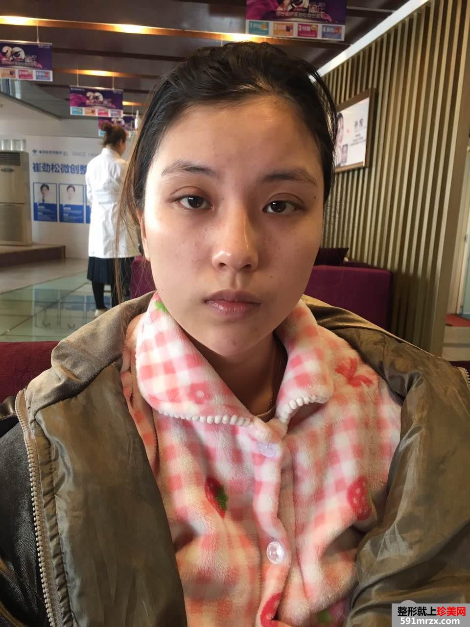 PRP自体脂肪面部填充效果图分享 脂肪存活率更高