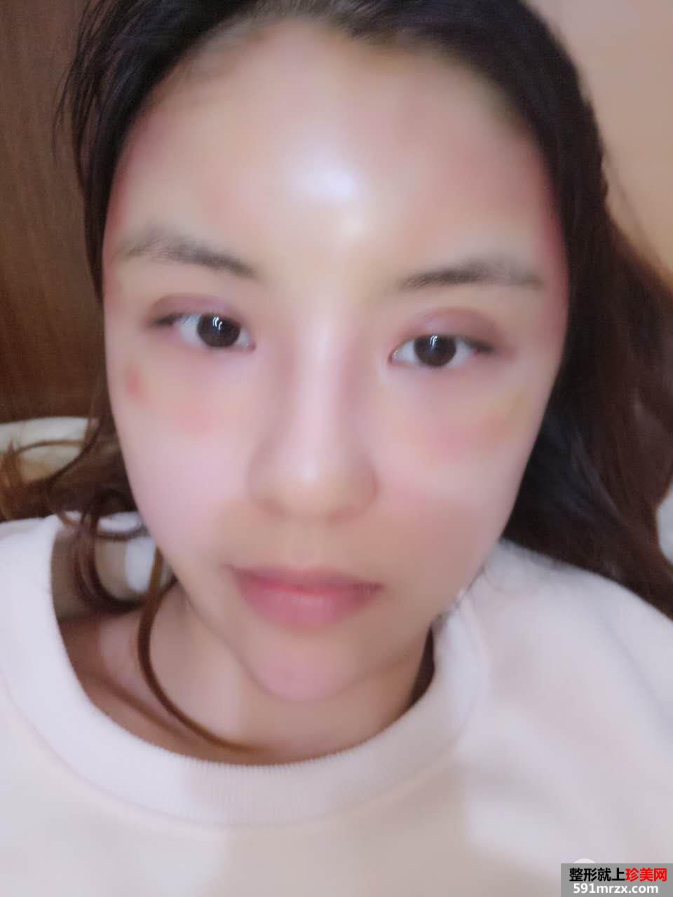 PRP自体脂肪面部填充效果图分享 脂肪存活率更高
