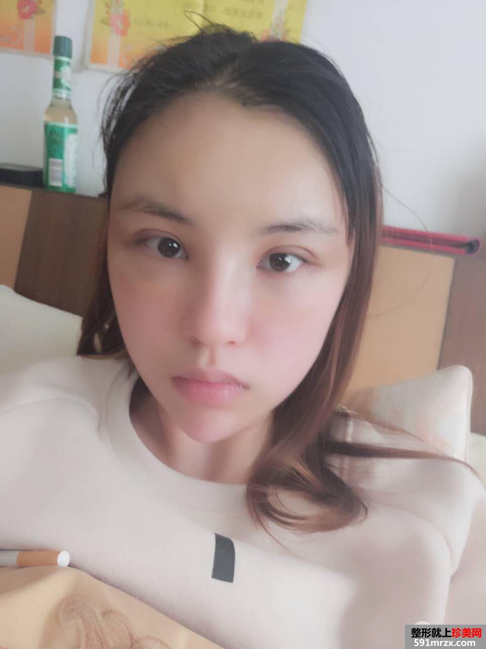 PRP自体脂肪面部填充效果图分享 脂肪存活率更高