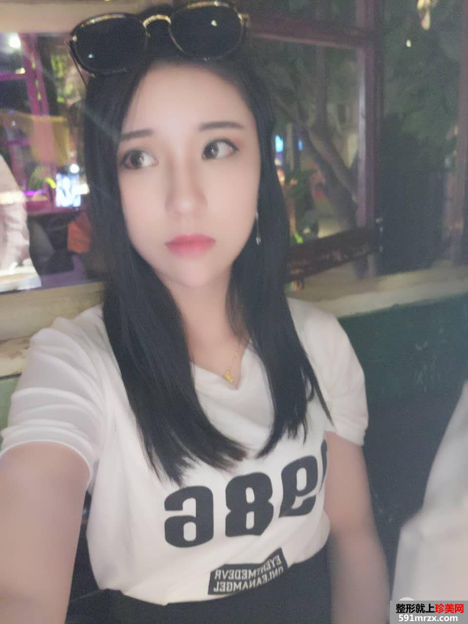PRP自体脂肪面部填充效果图分享 脂肪存活率更高