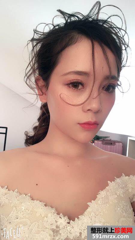 韩式三点双眼皮真实案例对比照片打造混血小美女