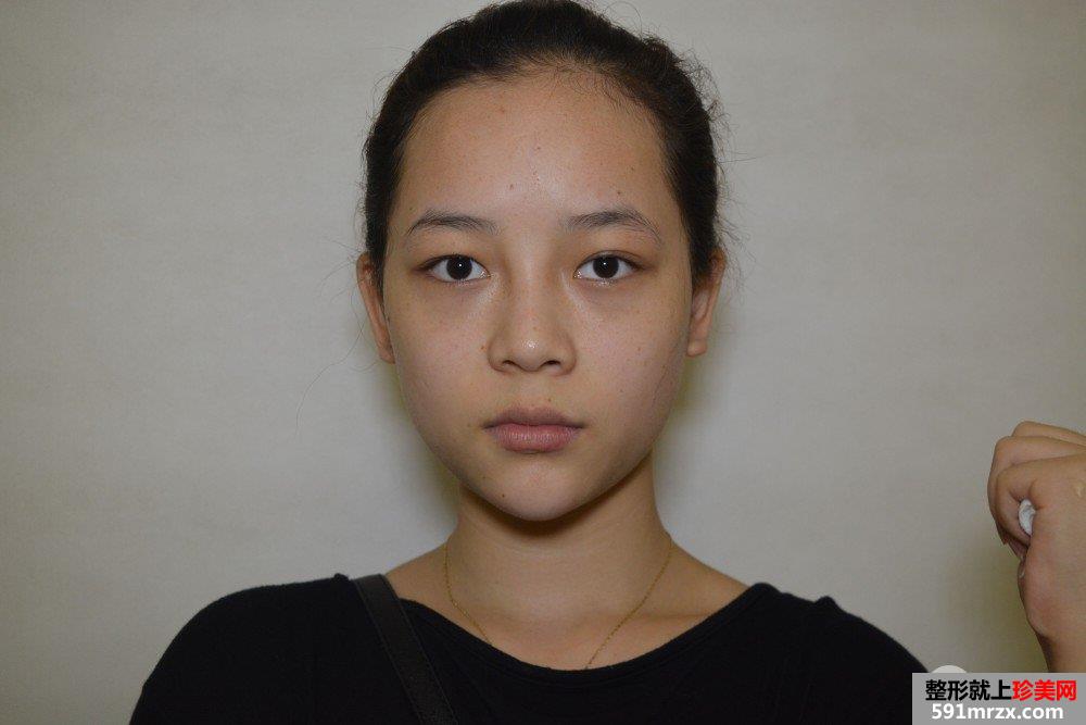 韩式三点双眼皮真实案例对比照片打造混血小美女