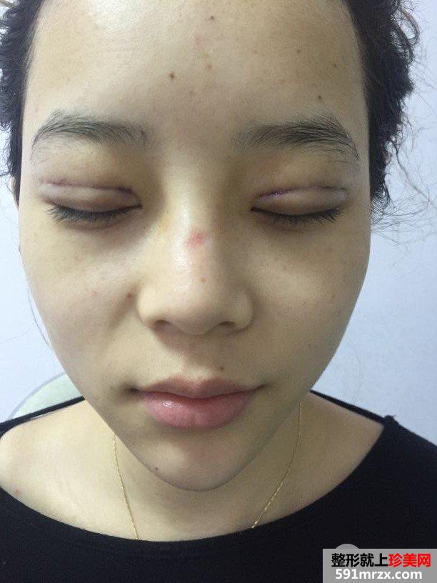 韩式三点双眼皮真实案例对比照片打造混血小美女
