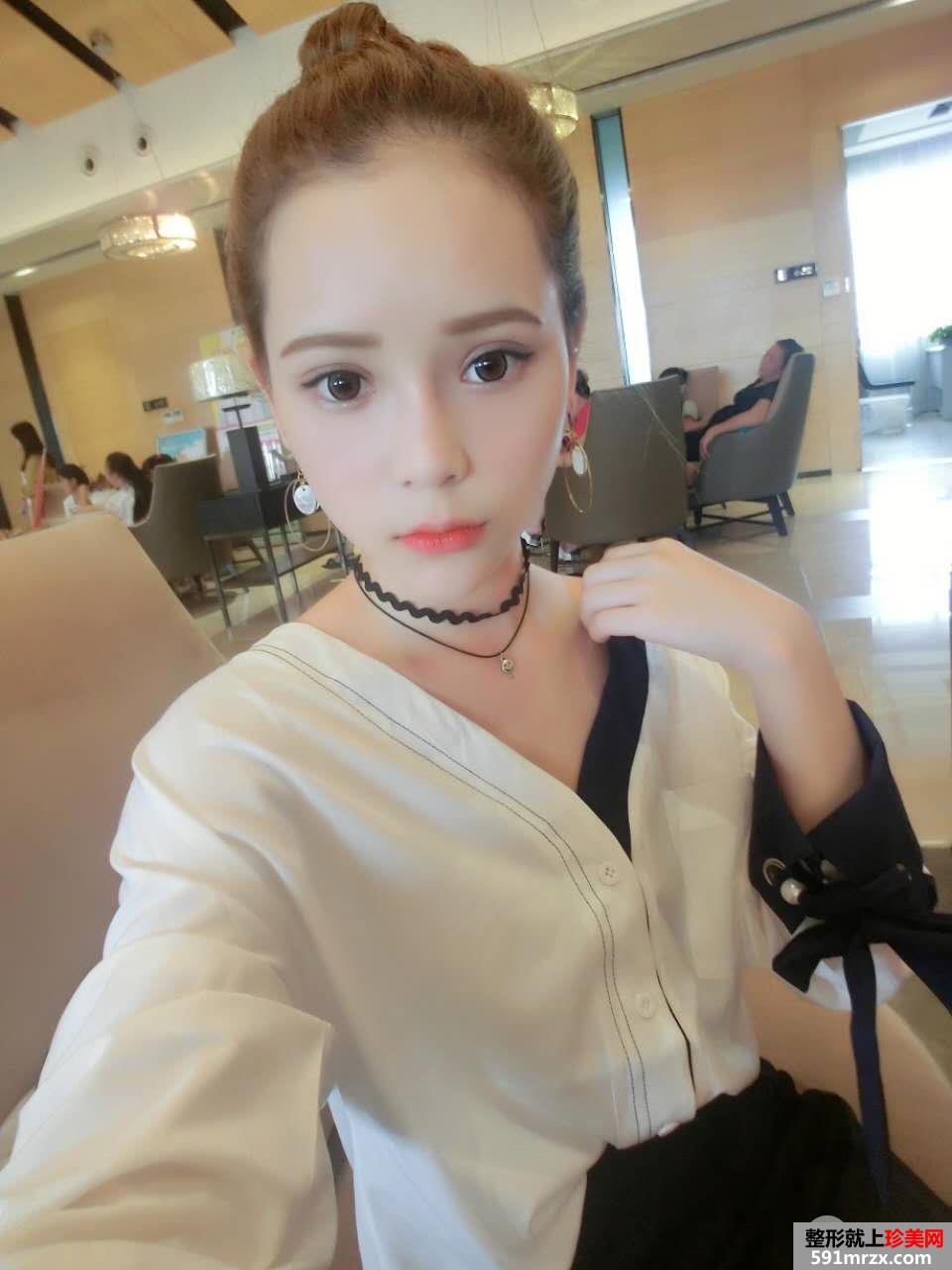 韩式三点双眼皮真实案例对比照片打造混血小美女