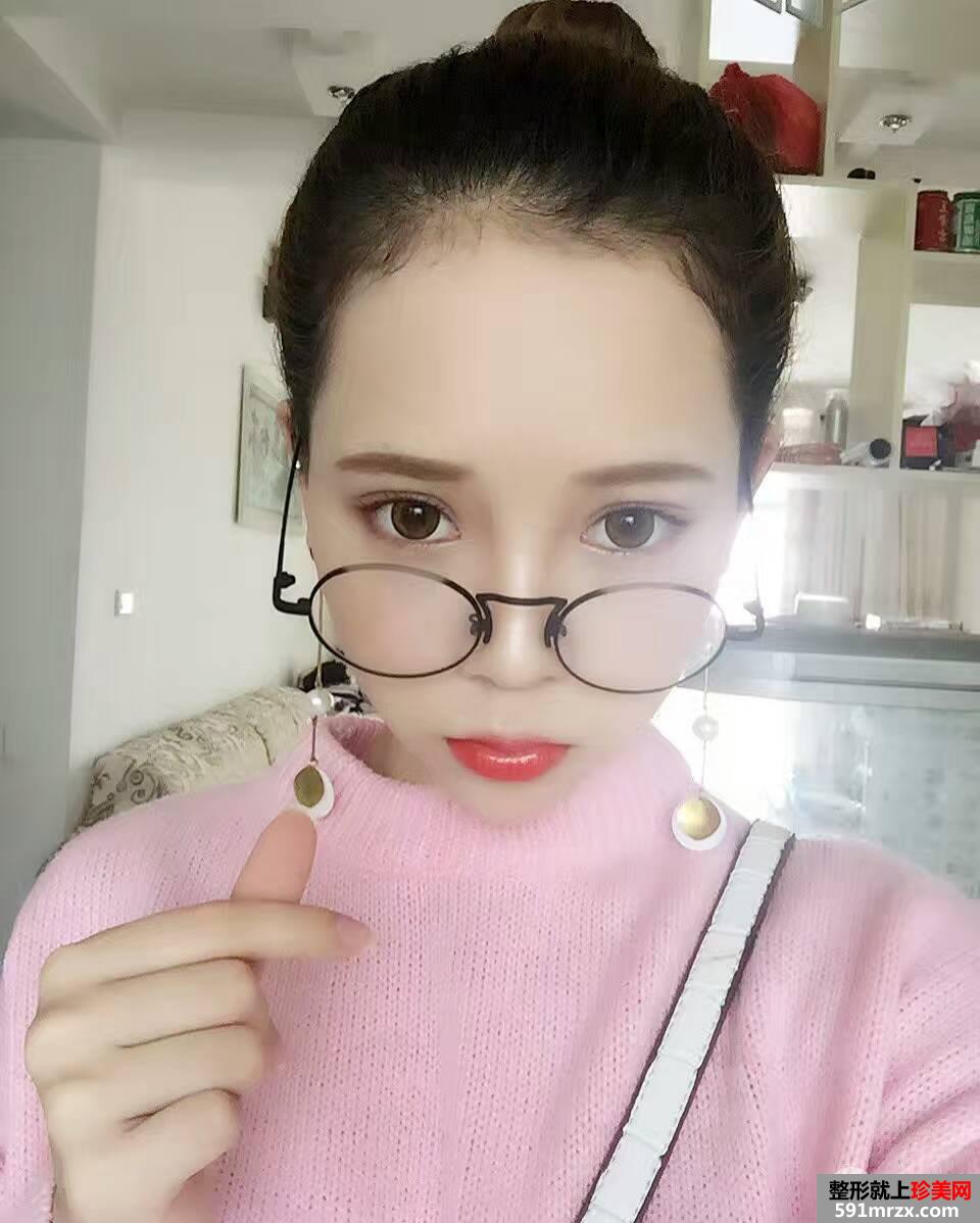 韩式三点双眼皮真实案例对比照片打造混血小美女