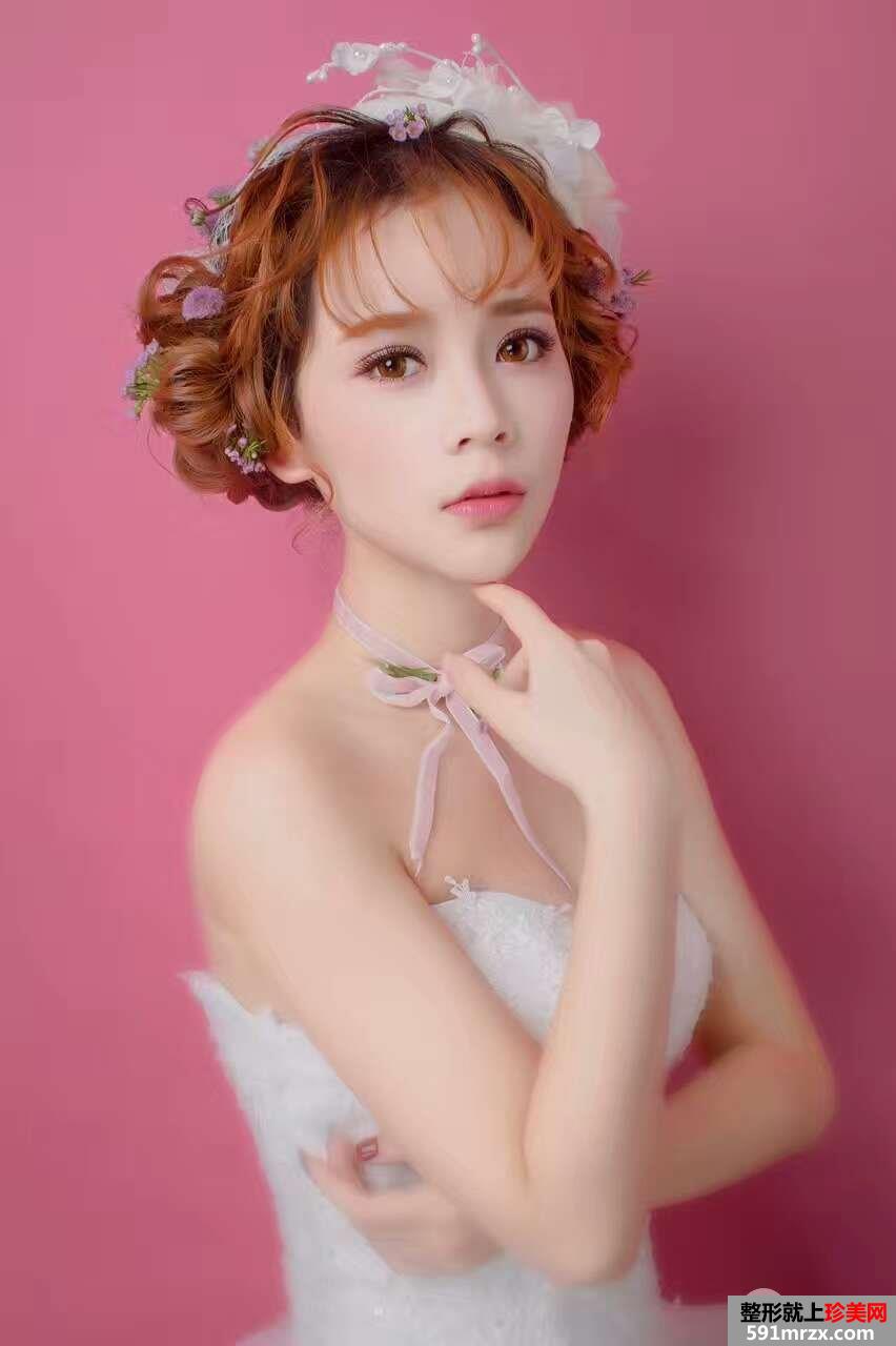 韩式三点双眼皮真实案例对比照片打造混血小美女