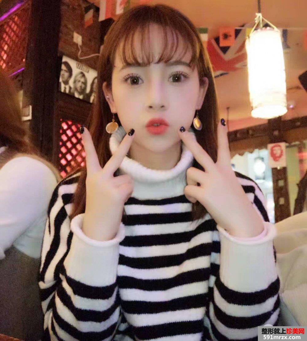 韩式三点双眼皮真实案例对比照片打造混血小美女