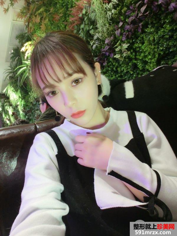 韩式三点双眼皮真实案例对比照片打造混血小美女