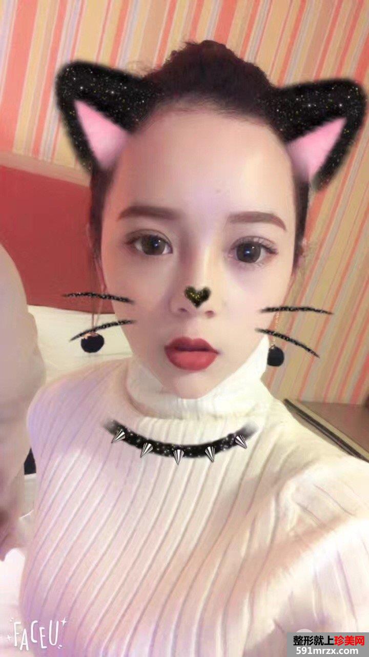 韩式三点双眼皮真实案例对比照片打造混血小美女