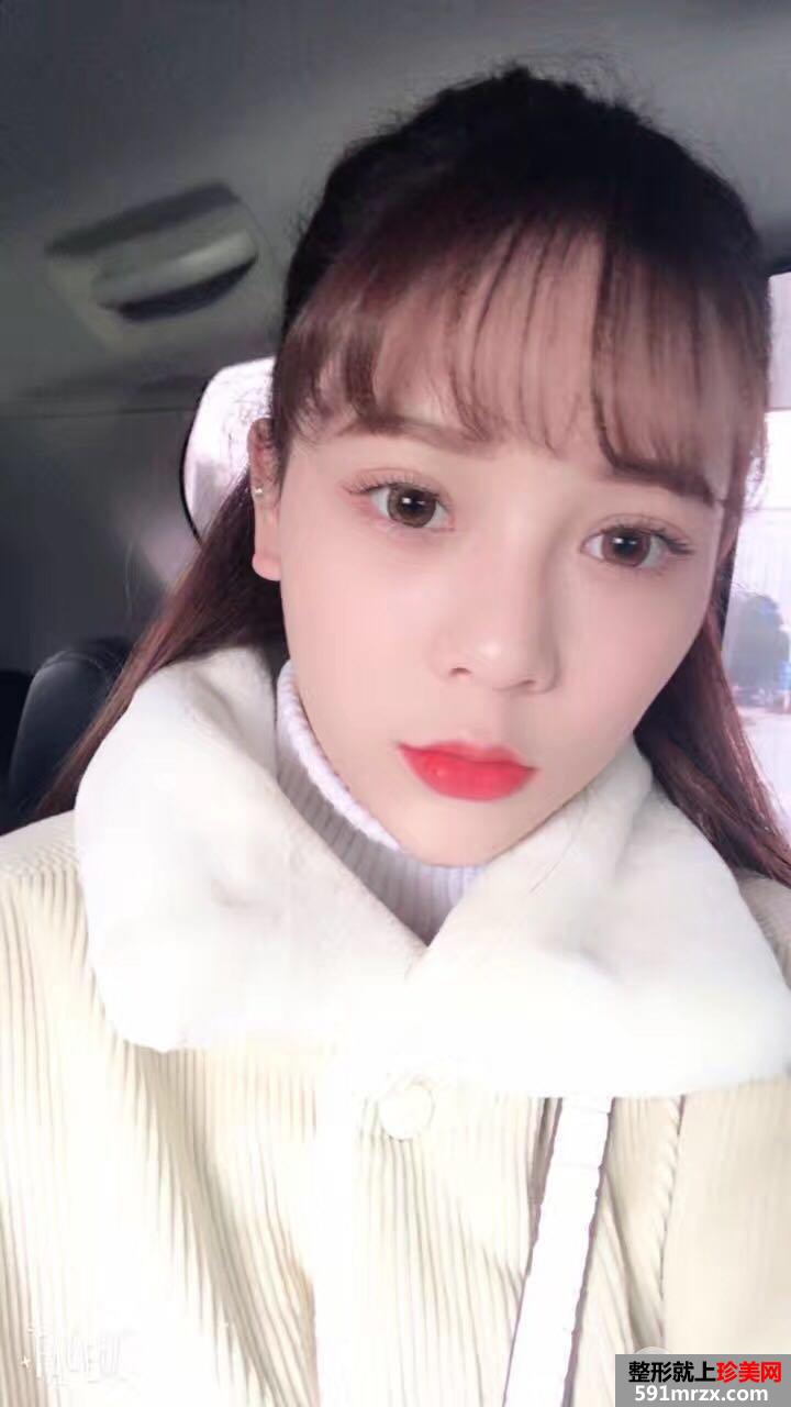 韩式三点双眼皮真实案例对比照片打造混血小美女