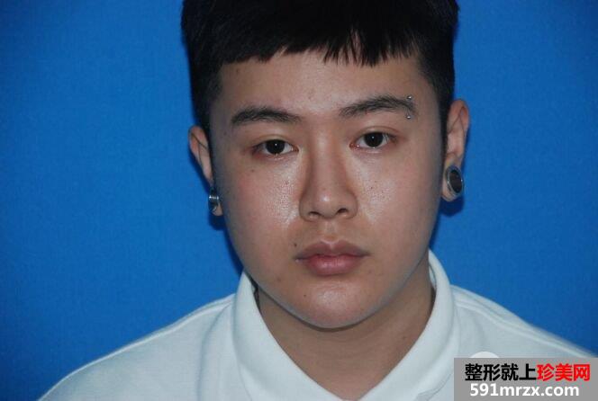 男生全切双眼皮+鼻综合整形手术过程分享 阳光帅气get！