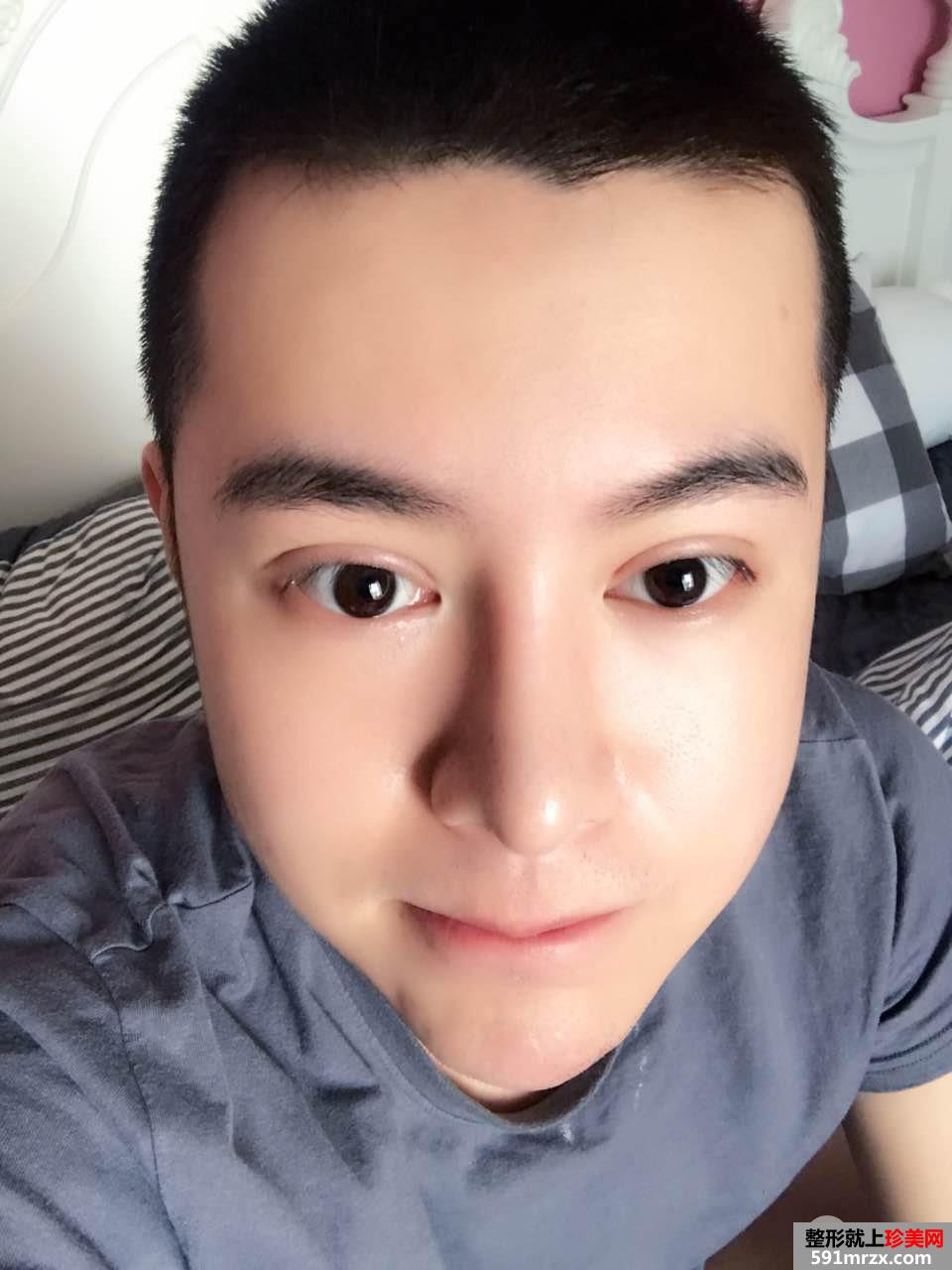 男生全切双眼皮+鼻综合整形手术过程分享 阳光帅气get！