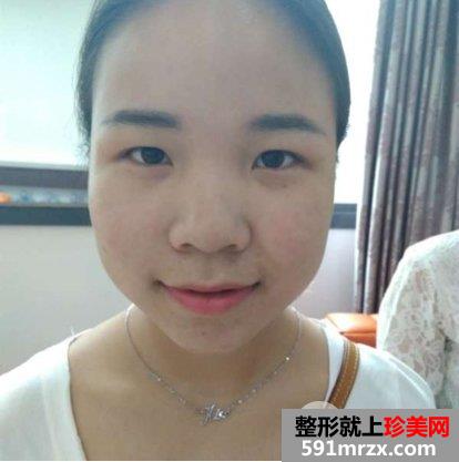 瘦脸针+综合鼻整形案例效果对比图变化惊人