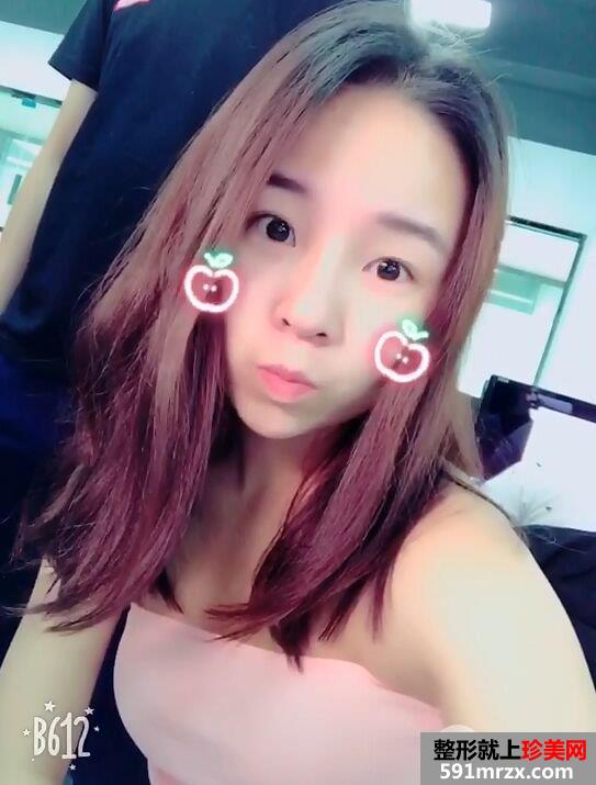 瘦脸针+综合鼻整形案例效果对比图变化惊人