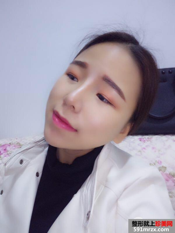 瘦脸针+综合鼻整形案例效果对比图变化惊人